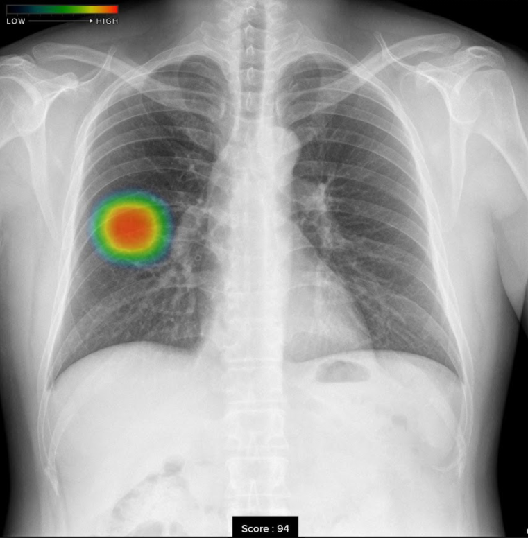 胸部X線画像病変検出ソフトウェア CXR-AID 胸部X線画像病変検出ソフトウェア CXR-AID
